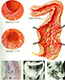 GNLD - COLITIS ULCERATIVA - NEO-LIFE