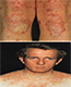 GNLD - DERMATOSIS DESCAMATIVAS - NEO-LIFE