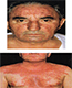 GNLD - ROSACEA - PITIRIASIS VERSICOLOR - NEO-LIFE